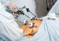 Chirurgie de pontage gastrique :aperçu