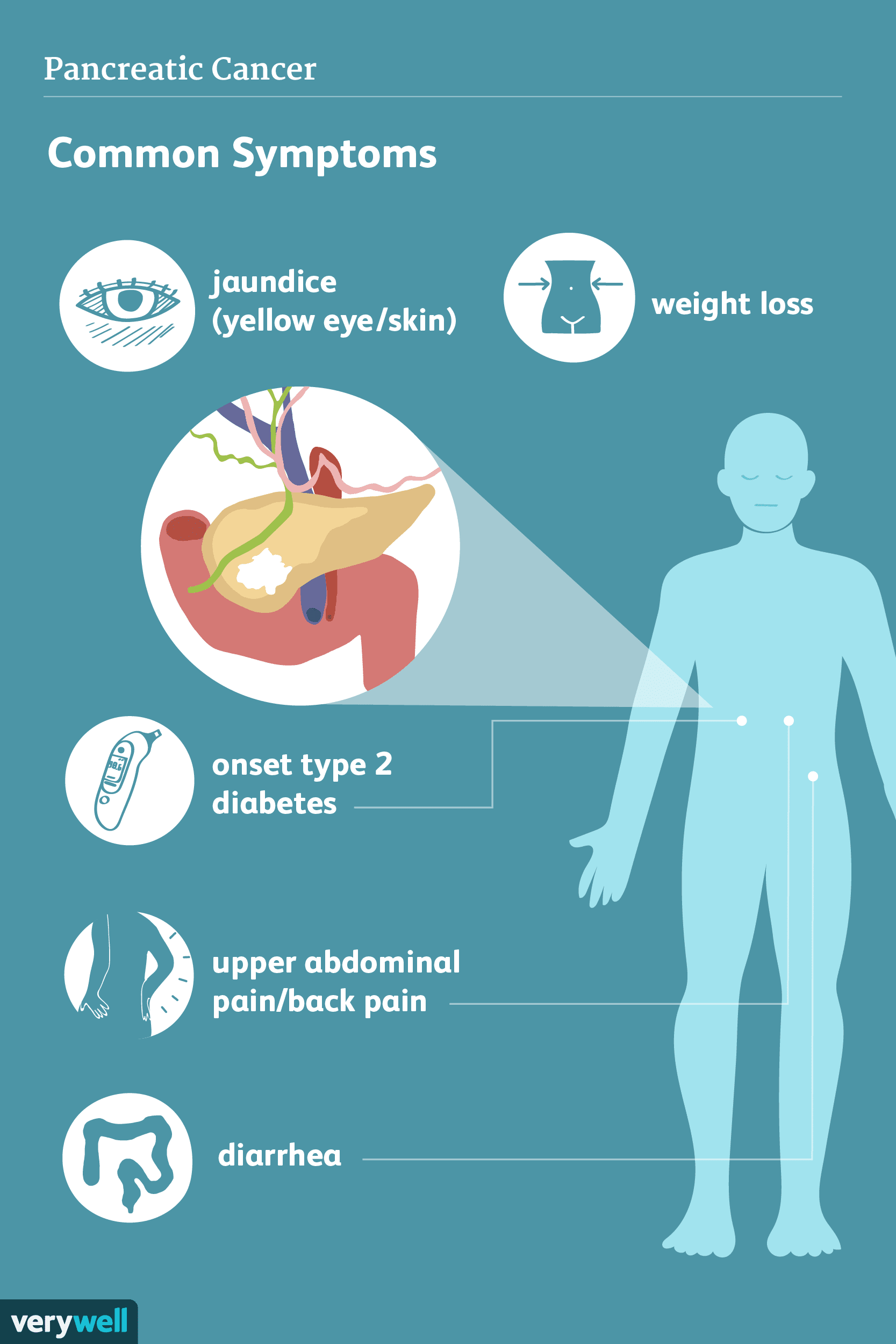 Symptômes du cancer du pancréas